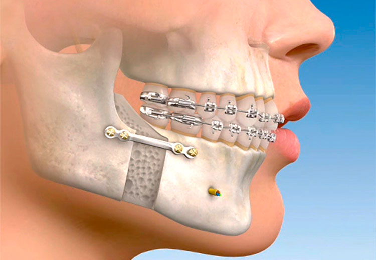 O Que Cirurgia Buco Maxilo Facial Alphasurgical